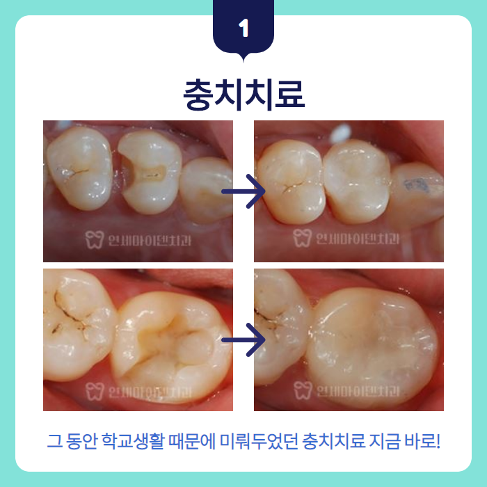 겨울방학 치과치료 (2).png