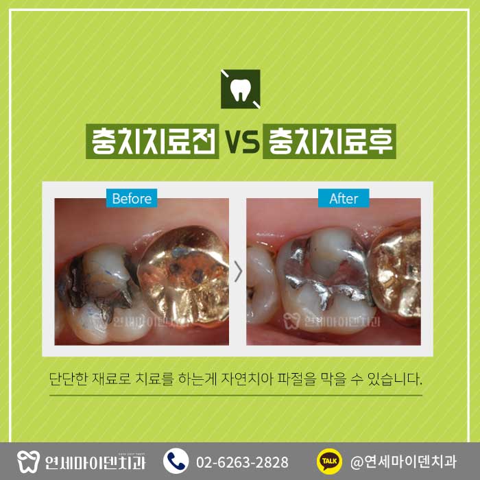 충치치료미루지말자 (4).jpg