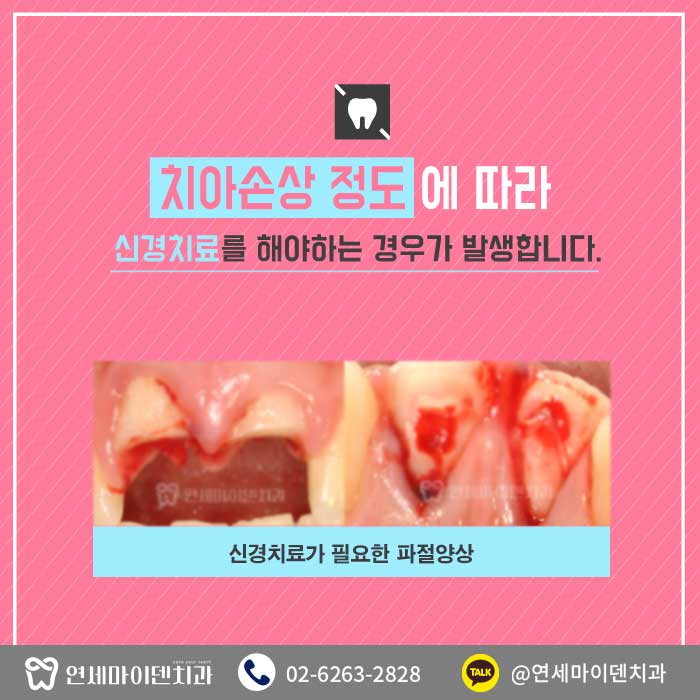 부러진치아레진치료 (2).jpg