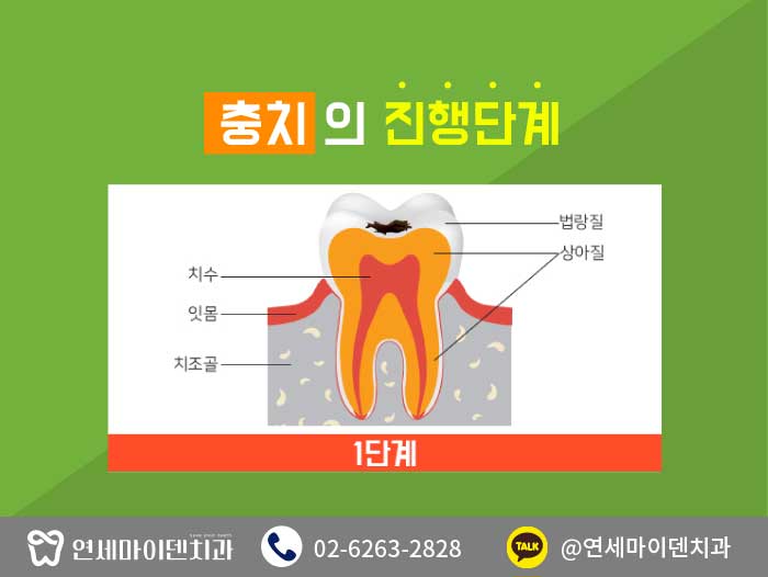 충치치료치아건강 (4).jpg