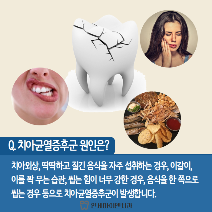 치아균열증후군 (4).png