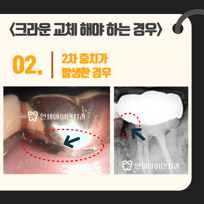 크라운 교체시기 (4).png