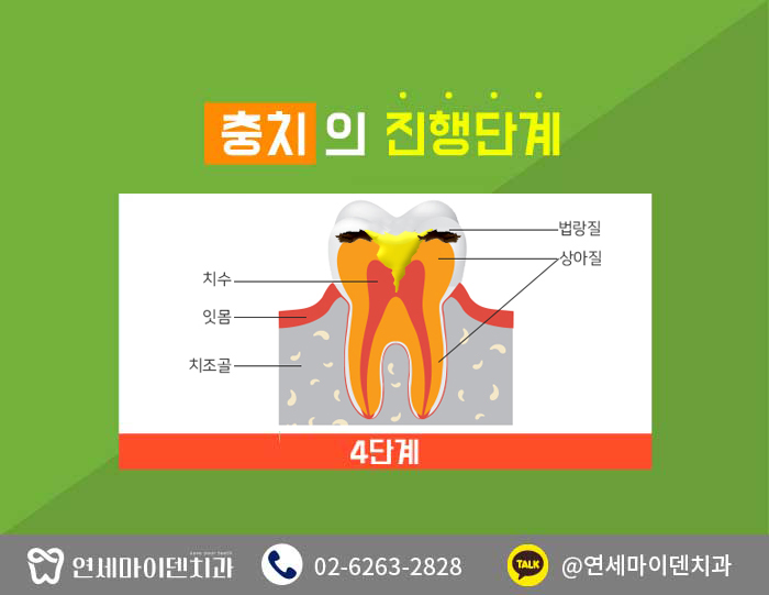 충치치료치아건강 (7).jpg