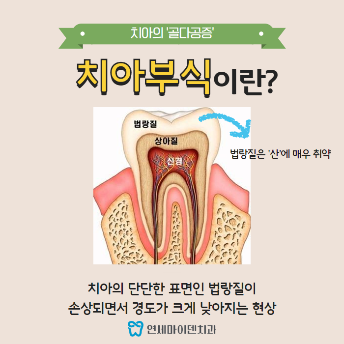 치아부식 예방법 (2).png