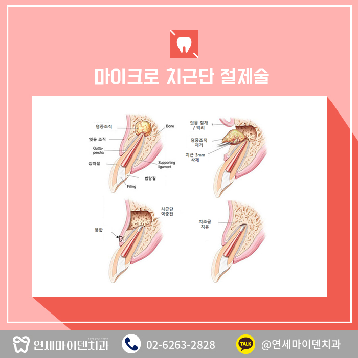 치아살리는수술방법 (2).jpg