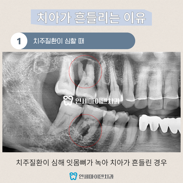 치아가 흔들리는 이유 (2).png