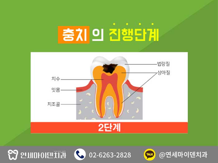 충치치료치아건강 (5).jpg