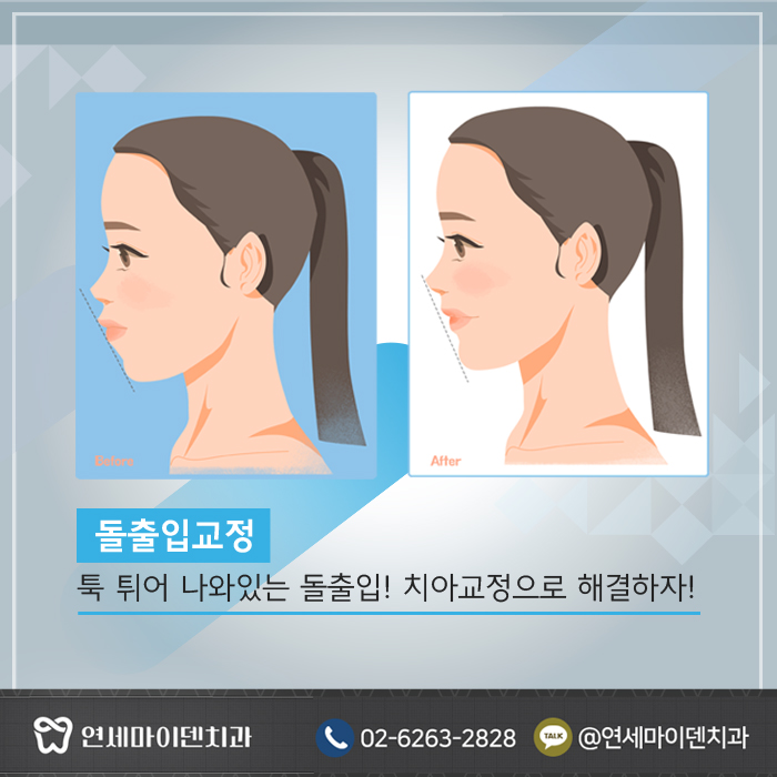 나에게 맞는 교정 (4).jpg