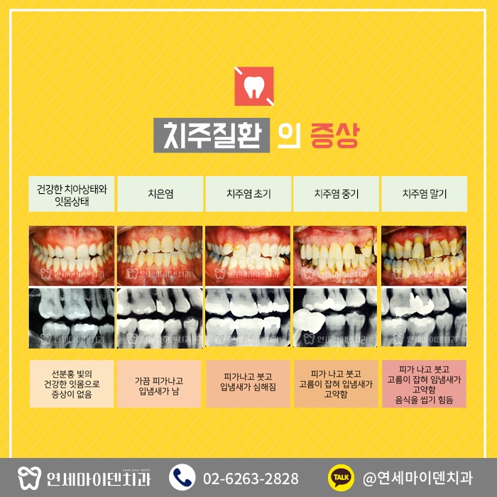 연세마이덴치과에서알려드리는치주질환 (4).jpg