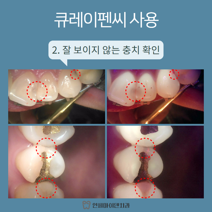 치아크랙, 충치검진 큐레이펜씨로 한번에! (4).png