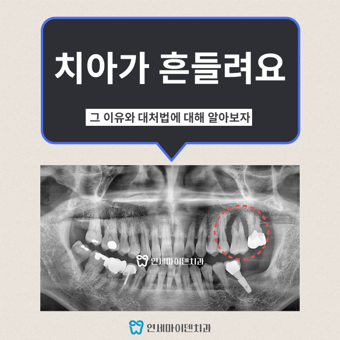 치아가 흔들리는 이유 (1).png