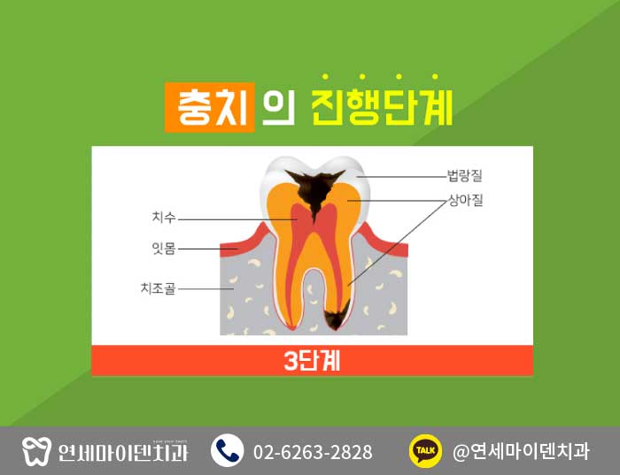 충치치료치아건강 (6).jpg