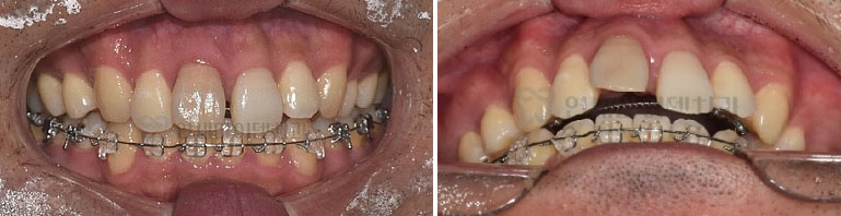 임플란트교정_002.jpg