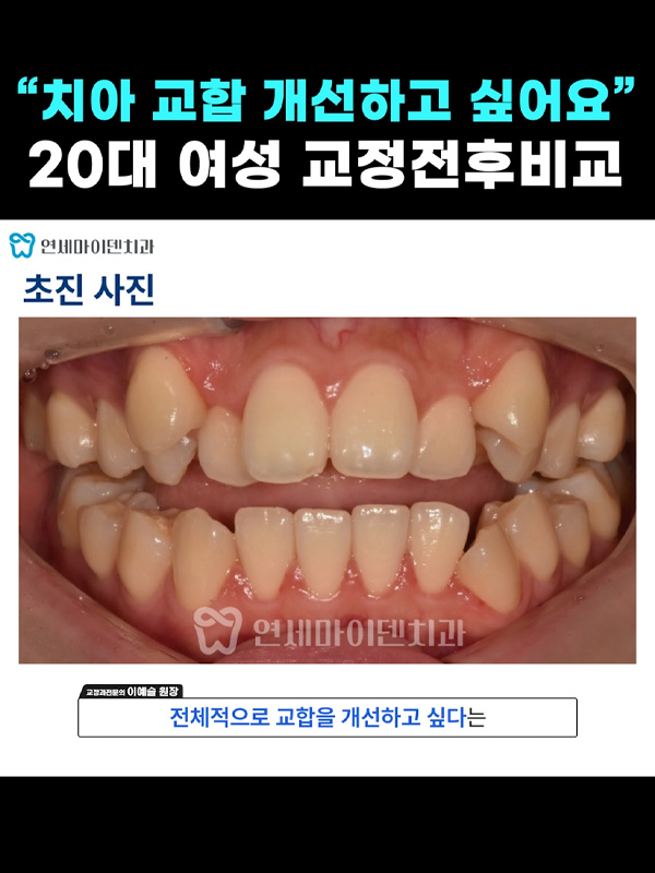 교정케이스21_admin_01.jpg