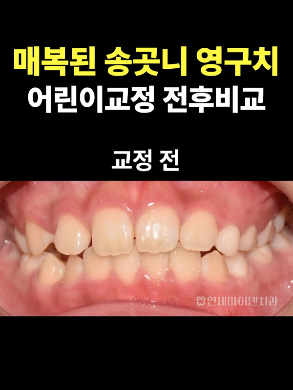 교정케이스23_admin_03.jpg