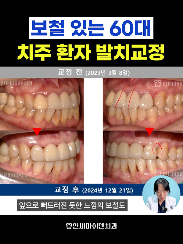 교정케이스24_admin_01.jpg