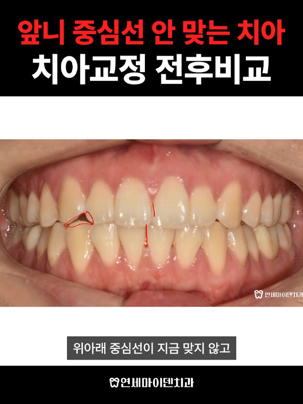 교정케이스11_admin_2.jpg