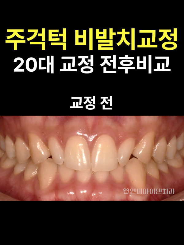 교정케이스26_admin_5.jpg